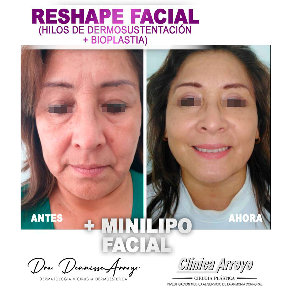 5 Facial Massages to help achieve Slimmer Face ✨, Gallery posted by Denise  Resueño