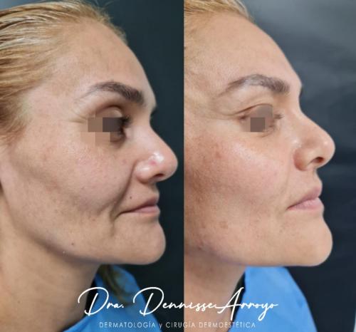 Dra-Dennisse-Arroyo-4-Dra-Denise-Arroyo-contouring